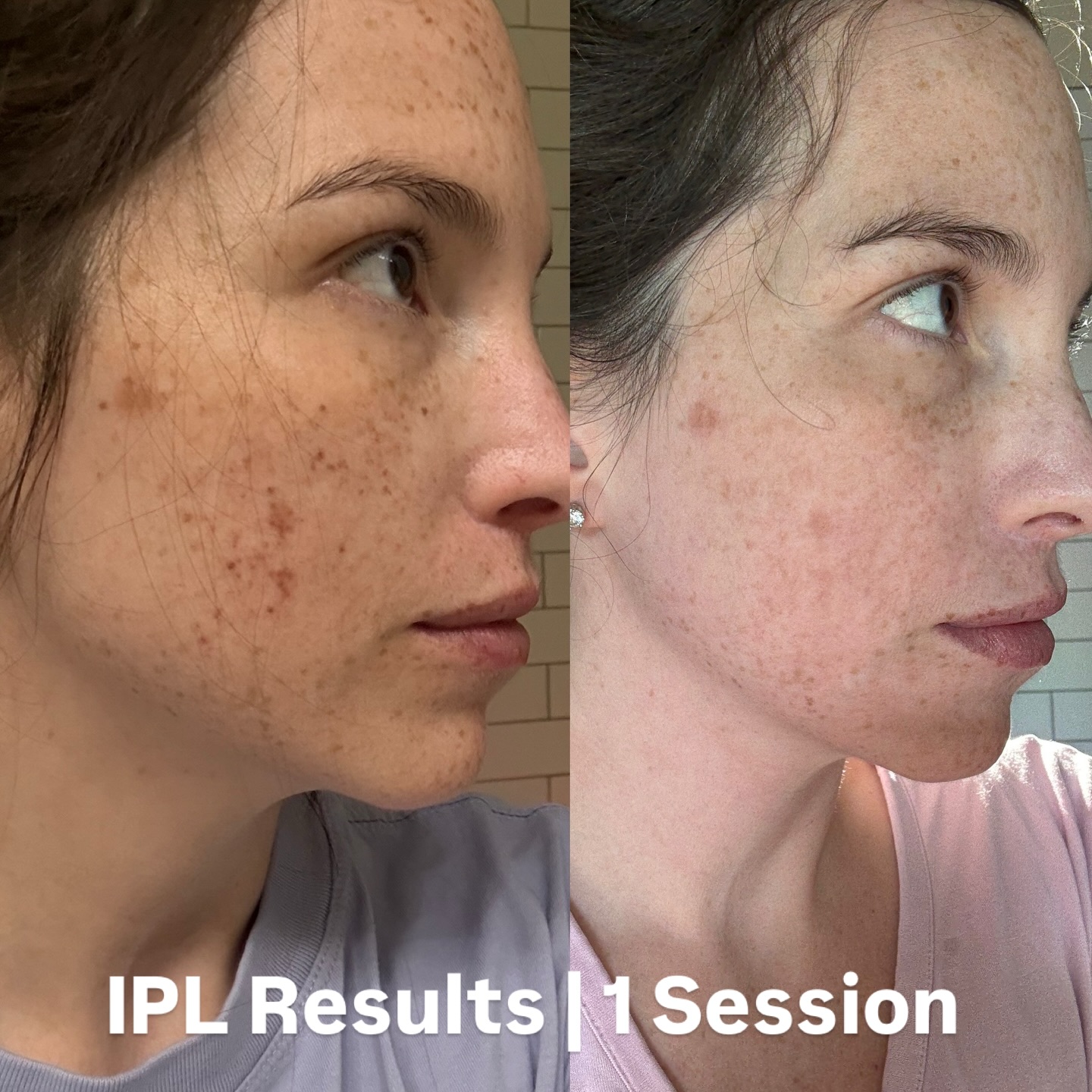 Patient IPL dark spot results after one session